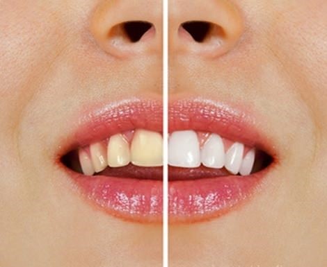 Günümüzde diş beyazlatmak oldukça önem arz etmesiyle birlikte Diş beyazlatma üzerine uzman hekimler ve gelişmiş teknoloji ile kısa süre içerisinde halledilmektedir.