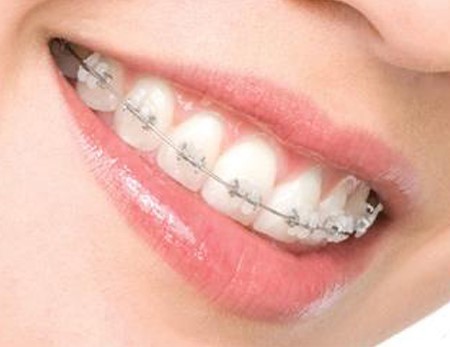 Diş Teli Tedavi Öncesinde Hekime Sorular