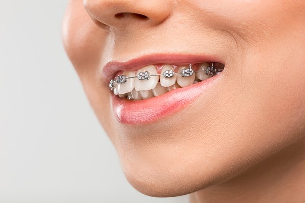 Diş Telinin Avantajları ve Dezavantajları
