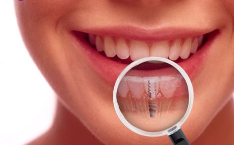 İmplant Diş Zararları var mıdır? İmplantın zararları hakkında bilgi almak isteyenleri yanıtlıyoruz.