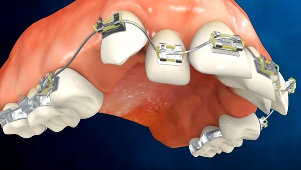 Diş telleri konuşmayı etkiler mi?