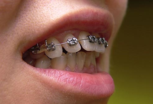 Diş teli ağrısı çok olur mu? Diş teli ağrısı ne kadar sürer? Diş teli ağrısı nasıl geçer?