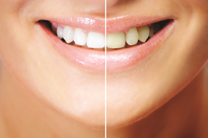 Lazerle diş beyazlatma nedir?  Lazerle diş beyazlatma nasıl yapılır?