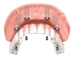 All On four dişsiz hastalara, toplam 4 implant kullanılarak protezin sabitlendiği yöntemdir.